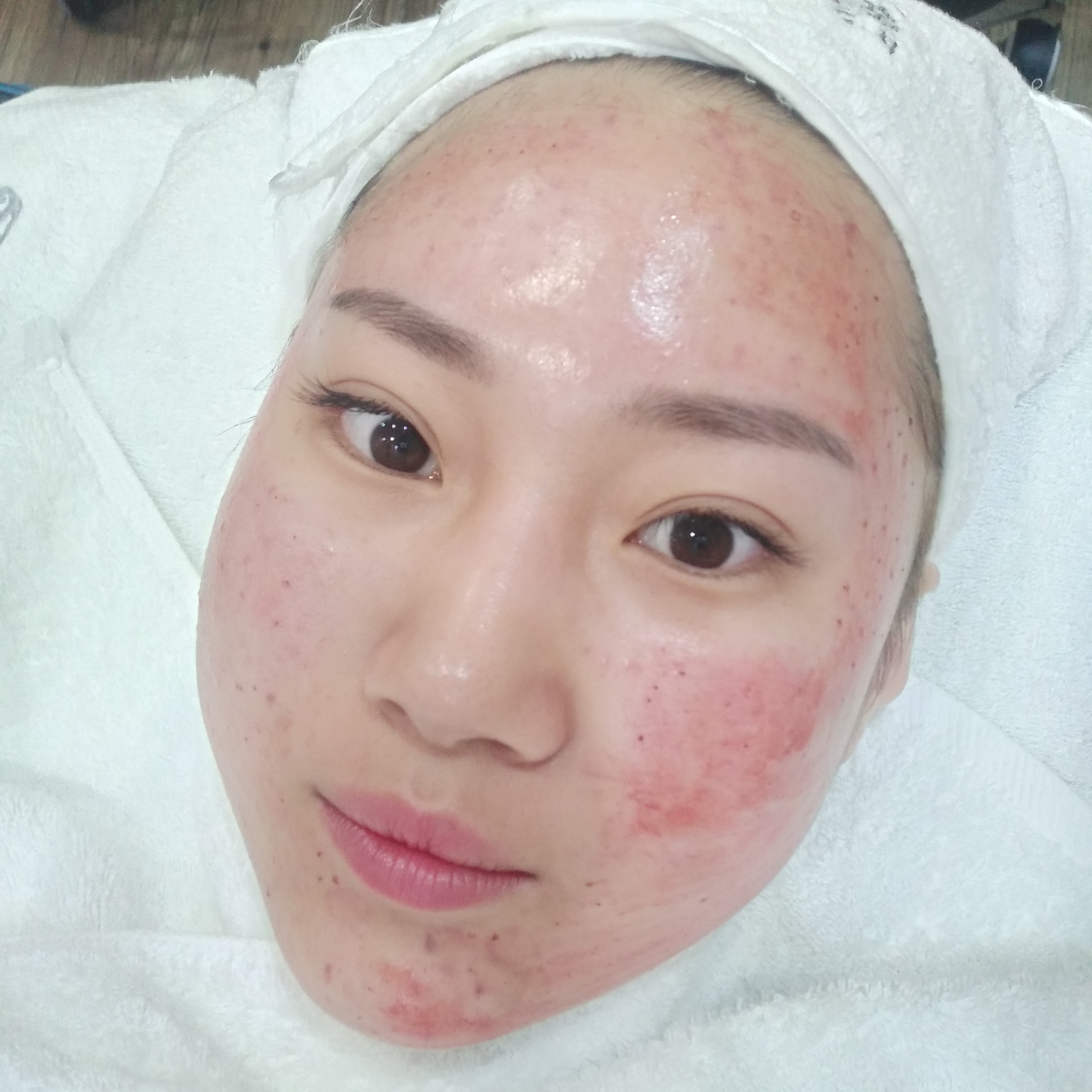 沈阳童颜医疗美容水光针怎么样?_最美苏妲己美丽日记-新氧美容整形