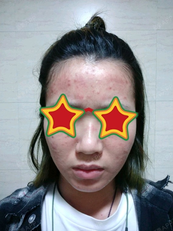 深圳微针美塑好不好_效果图_氧气bded62b微针美塑术后第2天_新氧美容