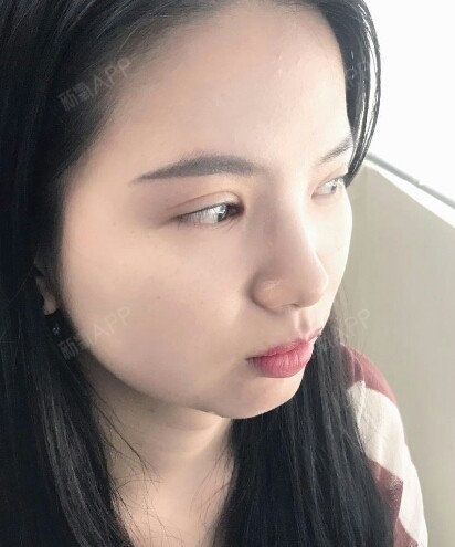 【深圳美莱】刚开完内眼角有的人会觉得眼角太尖,很不习惯,这是因为