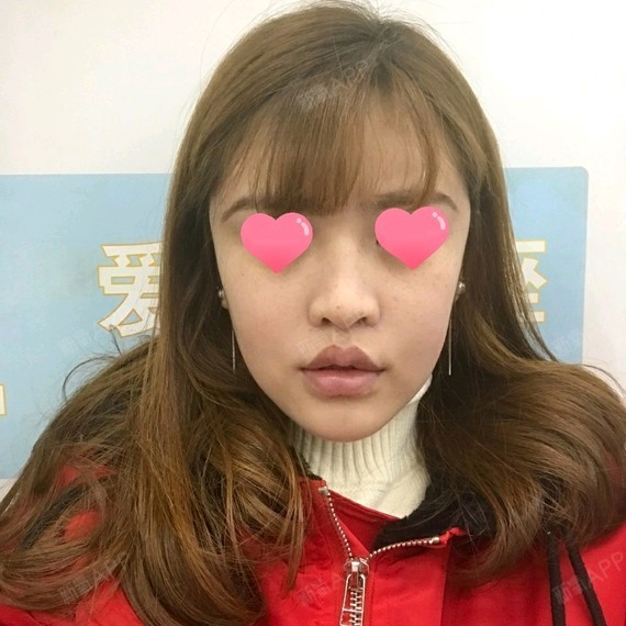 项目:硅胶隆鼻,手术缩鼻头,驼峰矫正客人本身鼻