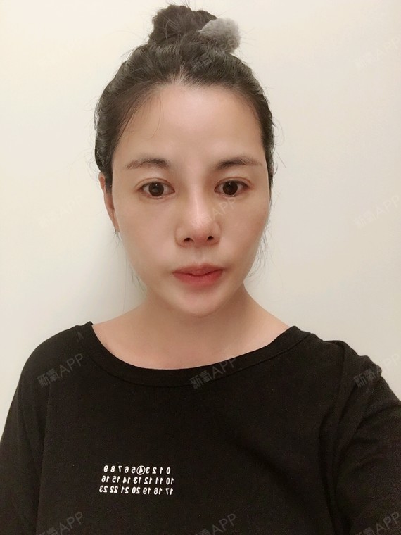 今天我的鼻子已经满一个月了,恢复的真的很不错,医生的审美真的太重要