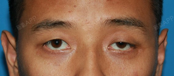 今天遇到一个左侧上睑下垂顾客,左下眼睑赘生物.