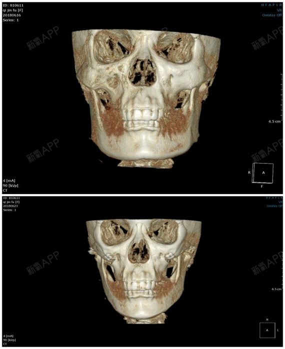 術後第15天下面發下ct圖感覺變了不少顴骨進去了且骨縫處鏈接挺好大