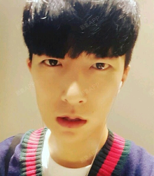 趁着休息去做了自体脂肪填充,额头,太阳穴,脸颊这些_圈子-新氧美容