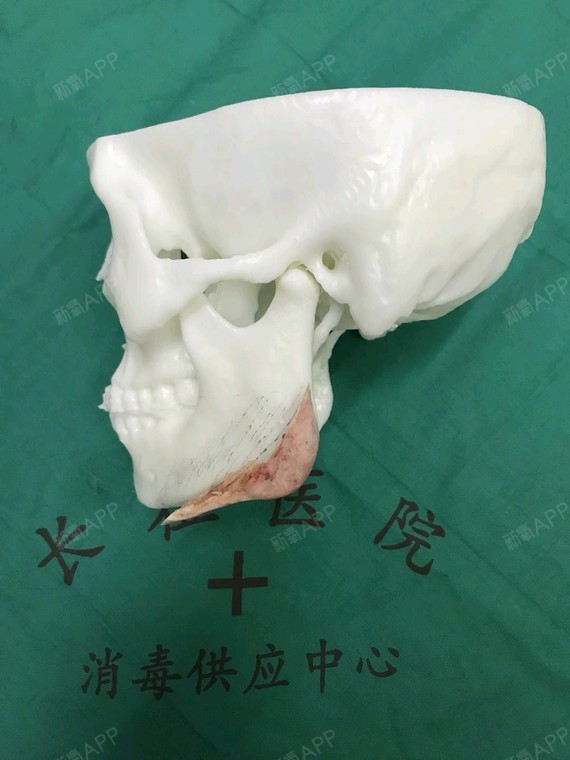 切下来的大下颌角都特别解气,让本姑娘这么多年心理阴影,不自信,遮脸