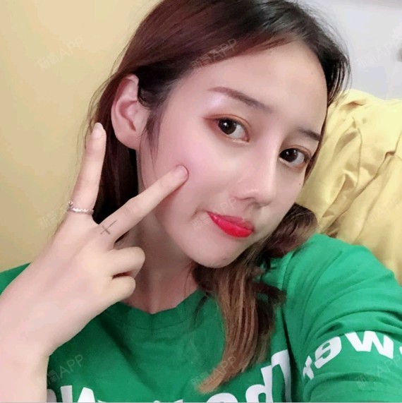 重庆膨体隆鼻好不好_效果图_仙界小机灵膨体隆鼻术后第65天_新氧美容