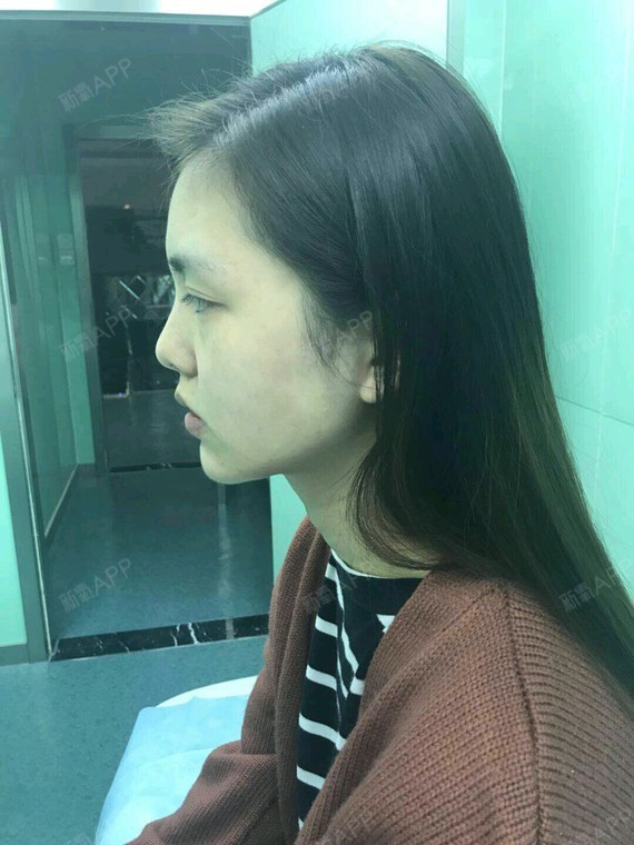 假体垫下巴手术危险吗_假体垫下巴一般多少钱_垫下巴假体