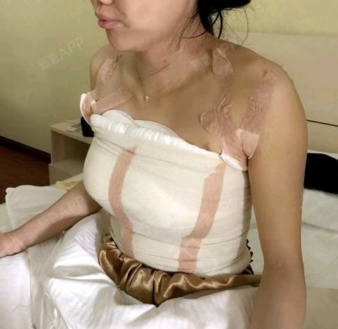 隆胸裹纱布美女隆胸纱布包扎图丰胸手术 纱布乳房手术包扎纱布相册