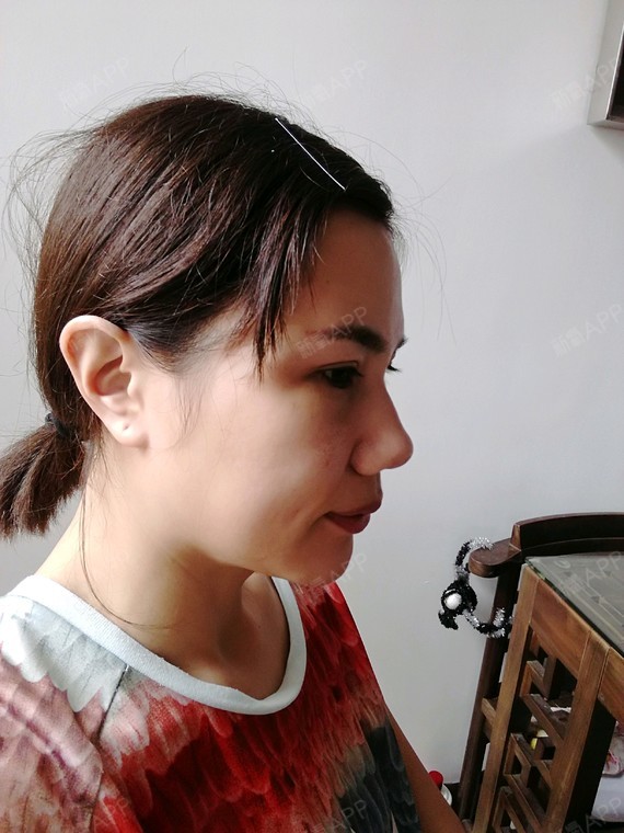 初期圆鼓鼓的额头_圈子-新氧美容整形