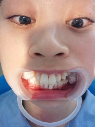 我选择的是陶瓷半隐形牙套,毕竟要窟个两三年的 满口钢牙的话我个人不