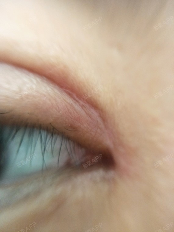 双眼皮 开眼角35天,增生很明显,请问现在涂疤克和_圈子-新氧美容整形