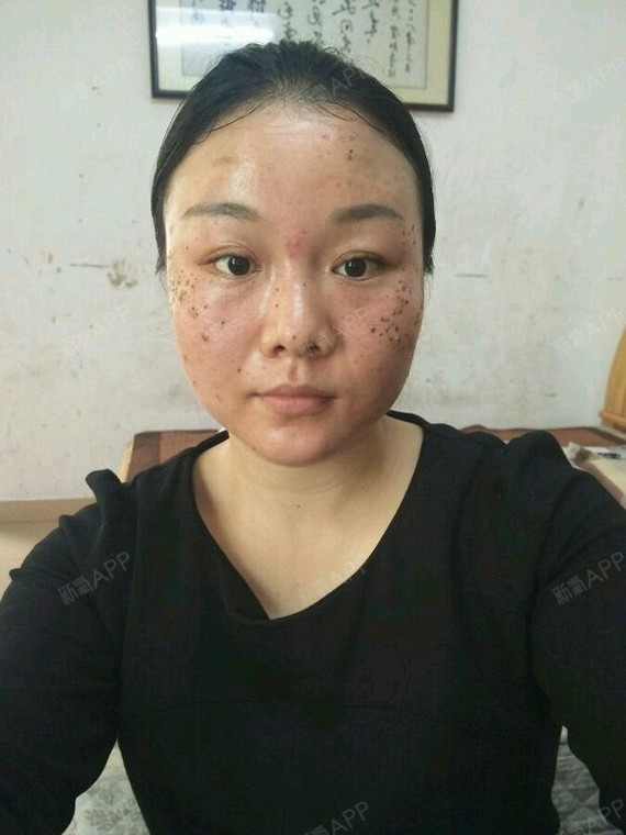 天津激光祛斑好不好_效果图_氧气xwrzf激光祛斑术后第10天_新氧美容