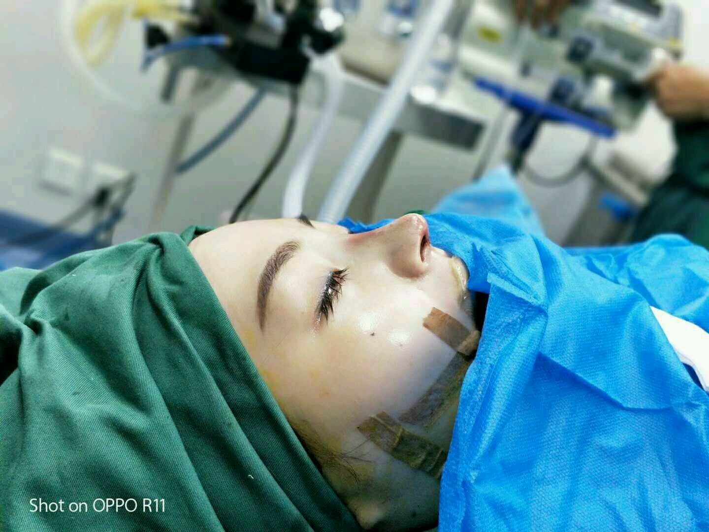 郑州元素美学整形肋软骨隆鼻怎么样?