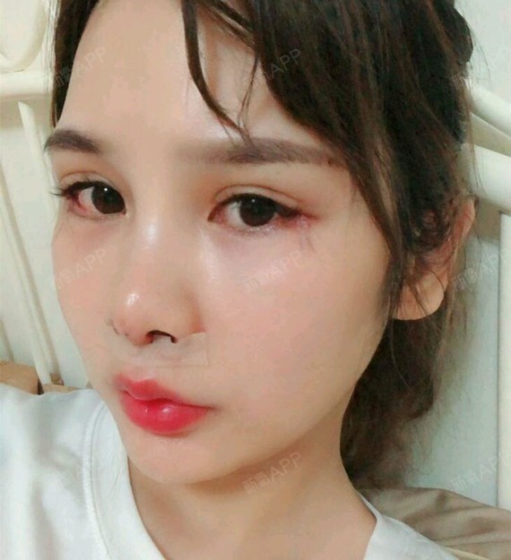 人中缩短术好不好_效果图_长桥栈道一丢丢人中缩短术术后第2天_新氧