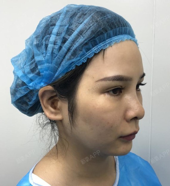 【菲丝澜人中缩短 外眼角修复 玻尿酸隆眉弓】一次做_圈子-新氧美容