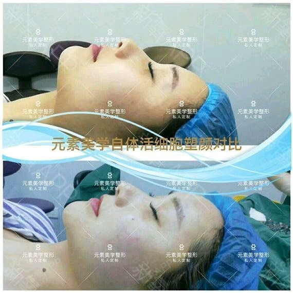 【郑州元素美学整形】同做脂肪填充,为什么你的存活率不如别人?