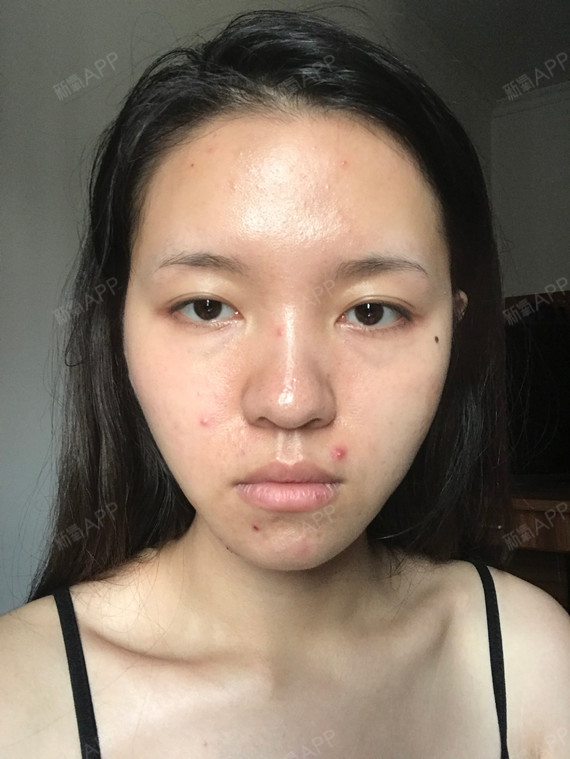 脂肪填充45天,皮肤什么的都好了好多.