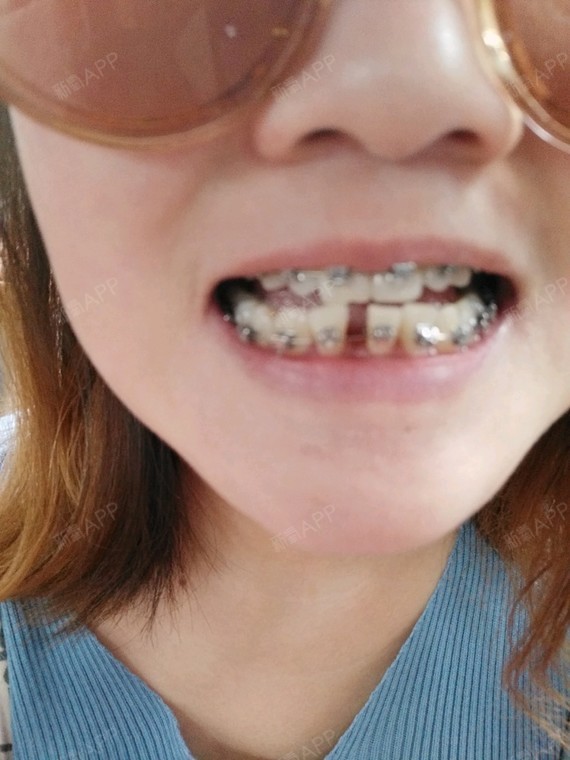 昨天去复诊了 ,给钢牙加力