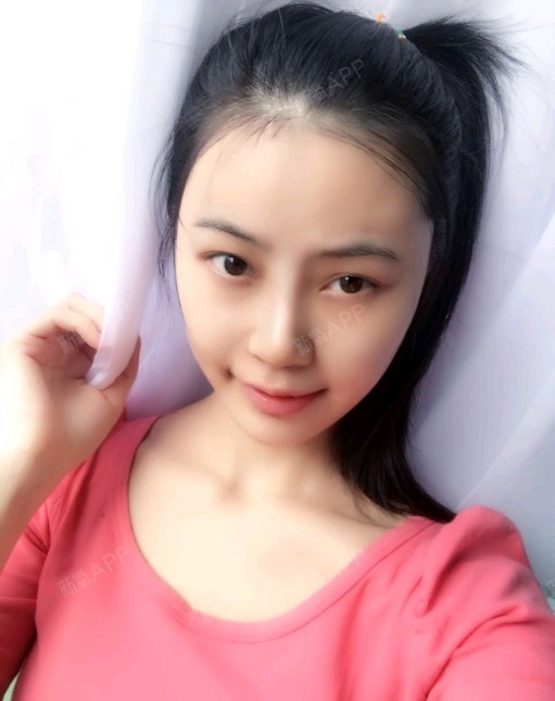 乐大喜膨体隆鼻第7天美丽日记