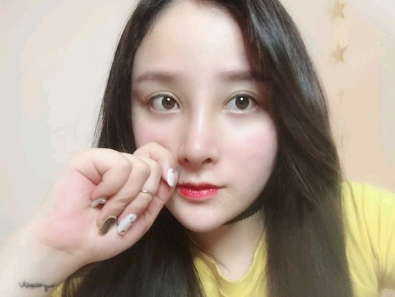 术后三天照片效果通过新氧消费方案查看手术延长鼻小柱手术轻度疼痛鼻