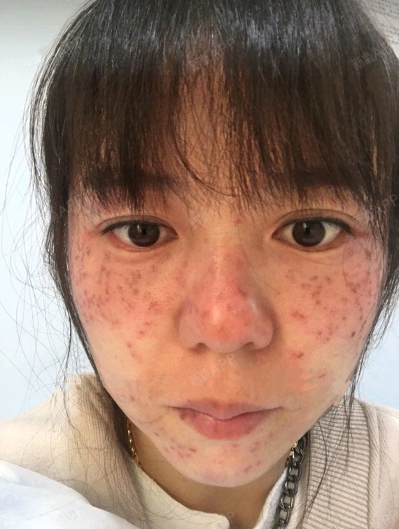 激光祛斑当天效果