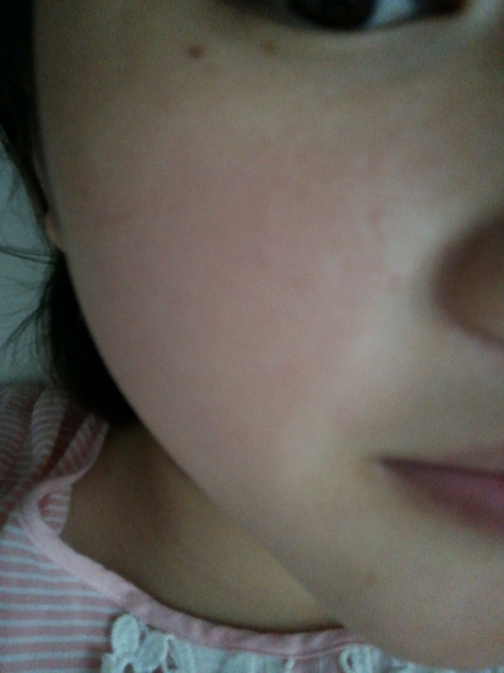 今天点痣第六天了大部分的痣结痂的都脱落了有粉色的小坑不知道多久