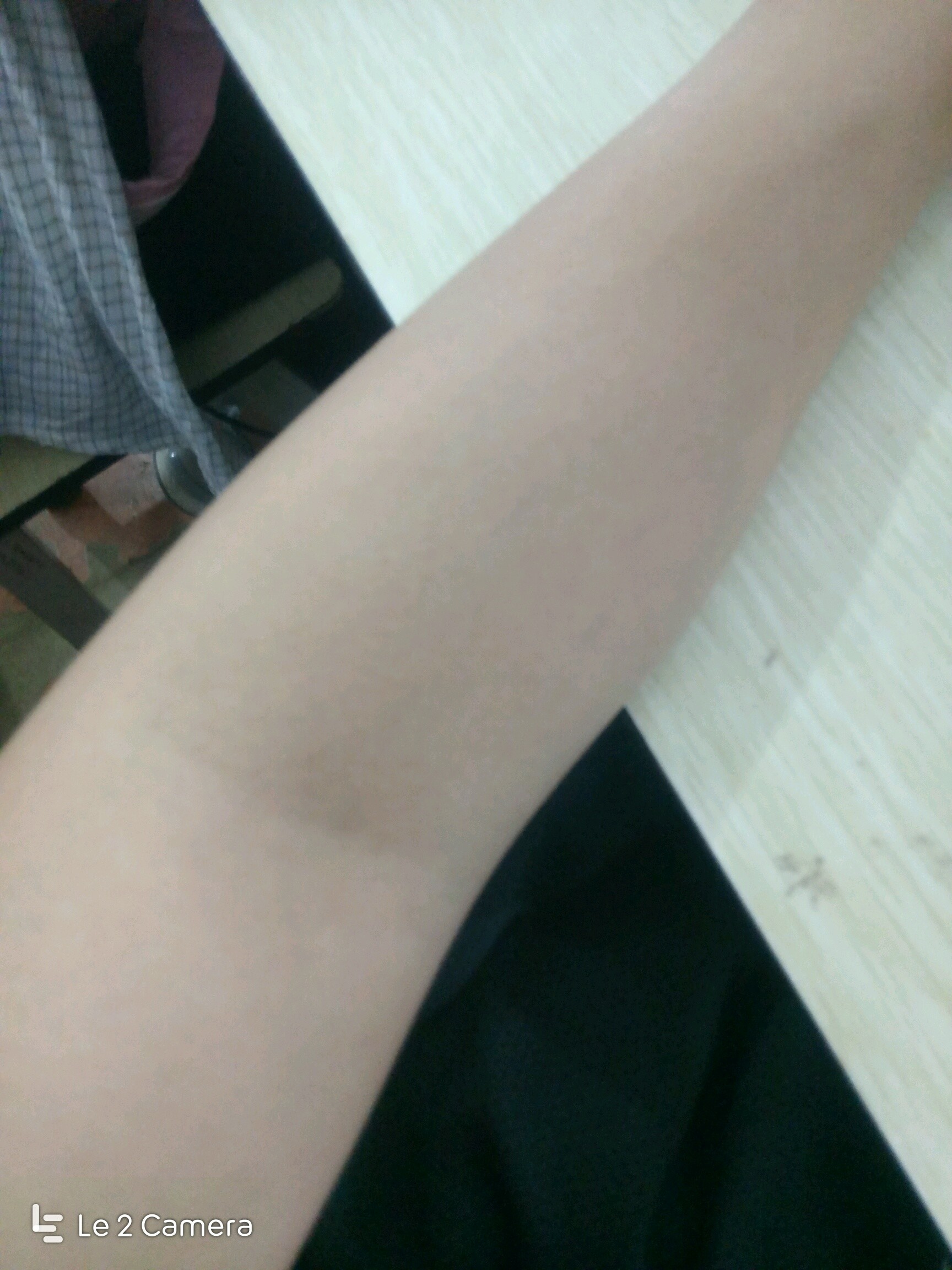 今天第一次脱手臂毛,这个是上手臂毛,感觉效果很好哦_圈子-新氧美容