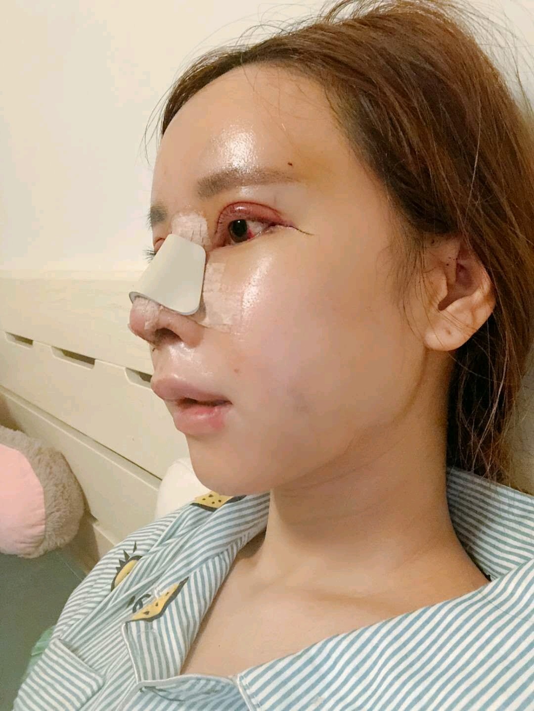 开内眼角怎么样_恢复过程_效果如何_爱吃番茄酱整形日记8.