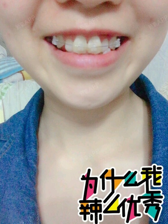 新氧 冰浅丹 牙齿 术后当自强 成都同城 金属托槽矫正