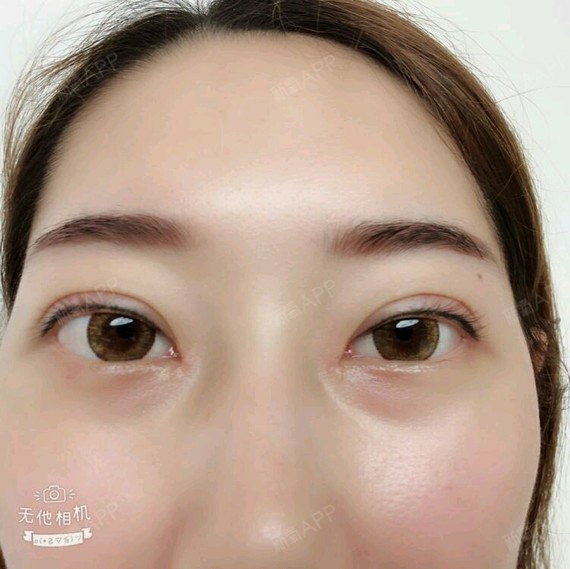 拆完线是不是就可以伤口快速的愈合了呢,真的越来越期待自己变得更