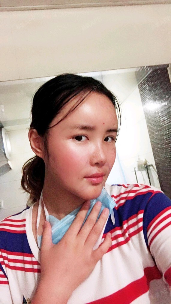我做脂肪填充第三天了,脸感觉消肿了一些,但是已经可_圈子-新氧美容