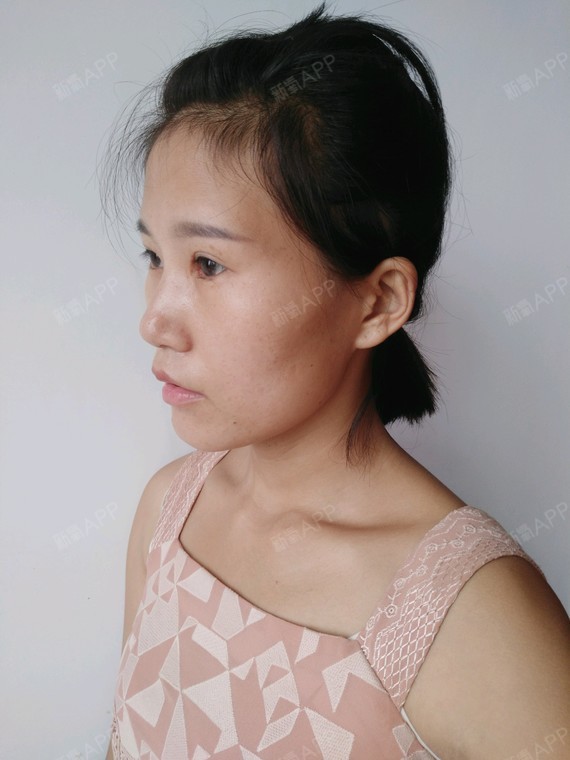 额头窄,颧骨高,下巴平,我脸型情况是不是适合玻尿酸_圈子-新氧美容