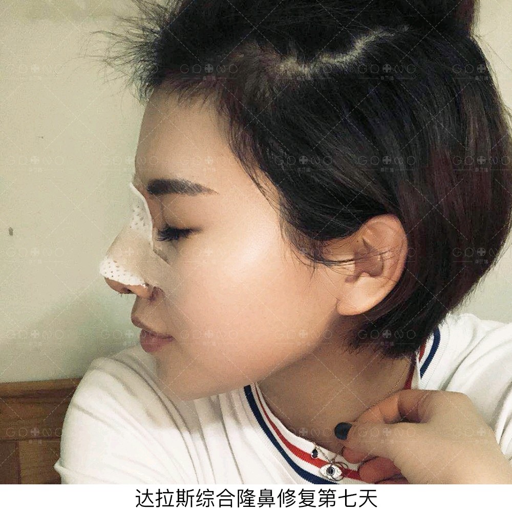 达拉斯综合隆鼻#小"刘涛"达拉斯综合隆鼻术后第七_圈子-新氧美容整形