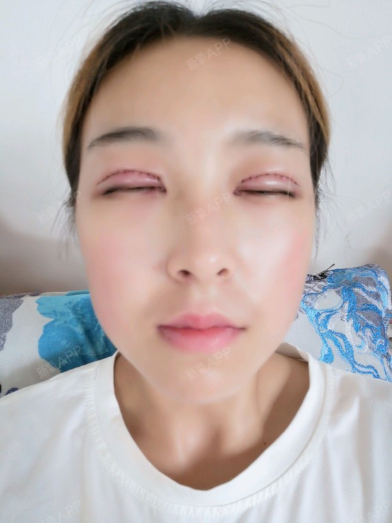 切开双眼皮