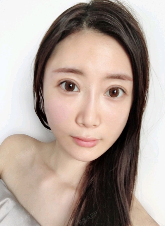 自体脂肪填充全脸