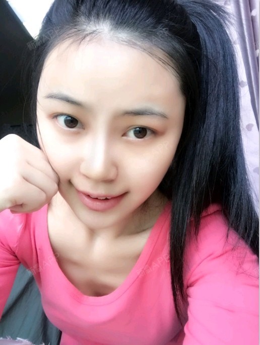 重庆膨体隆鼻好不好_效果图_乐大喜膨体隆鼻术后第13天_新氧美容整形