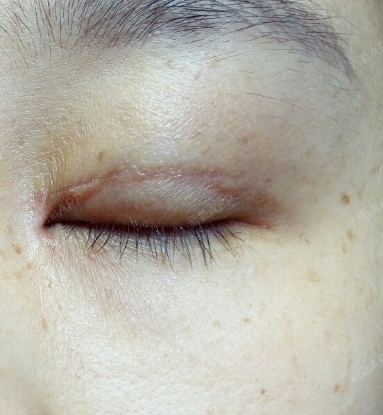 术后57天,去疤膏用了大概一个月了,感觉没什么效果