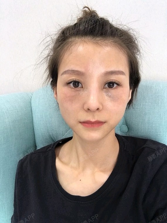 今天是线雕第三天了,脸看起来有点僵硬,但是看起来没_圈子-新氧美容
