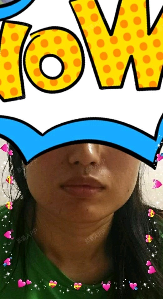 我是咬肌大  左右严重不对称  看看注射后能不能有变化