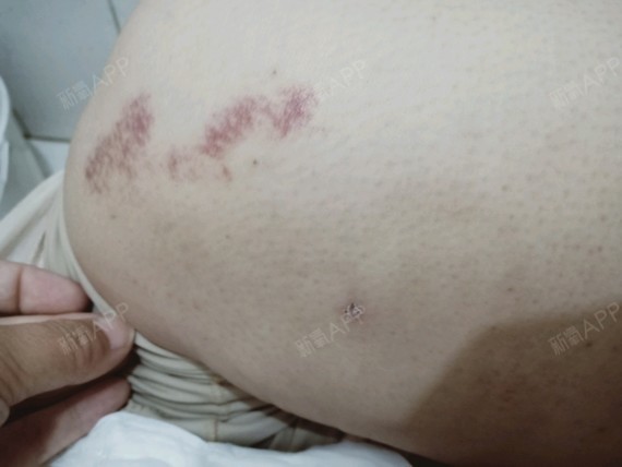 膝盖最明显的地方,也就一点点的疤痕,淤青的面积也是越来越小