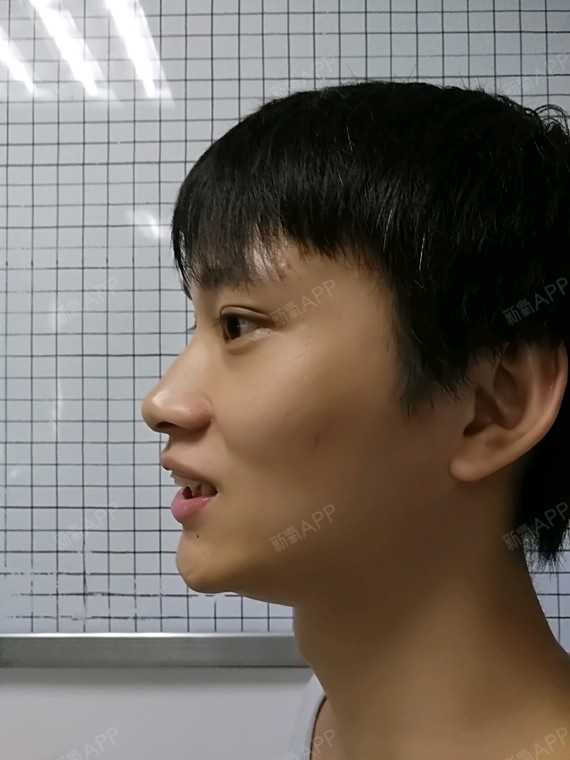 上海隐形托槽矫正好不好_效果图_深情不负隐形托槽矫正术后第0天_新氧