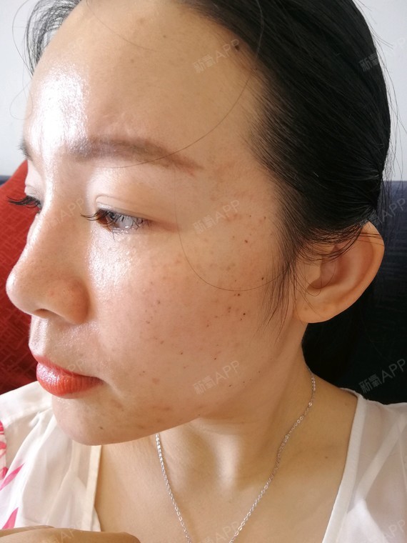 圆圆的脸皮秒激光第7天美丽日记