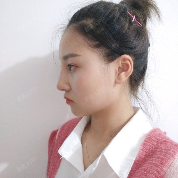 做了耳软骨假体鼻部多项都27天 山根还是好高 有跟我一样的