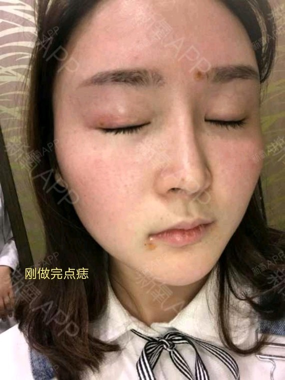 激光点痣的效果是真的好   过了很久   我脸上都没有留疤   这点是