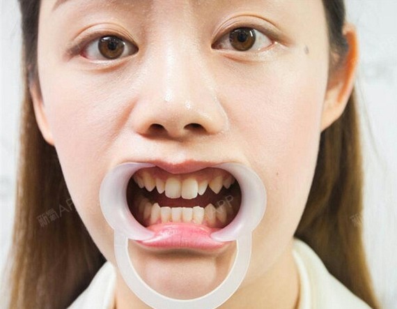 首先看看我的牙齿,典型的老鼠牙,大小不一,然后还不_圈子-新氧美容