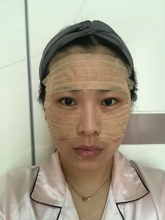 在重庆常青藤整形美容医院做自体脂肪全脸填充第三天啦_圈子-新氧美容