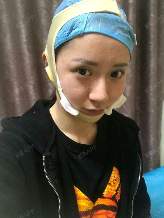 【下颚磨骨~瓜子脸手术】