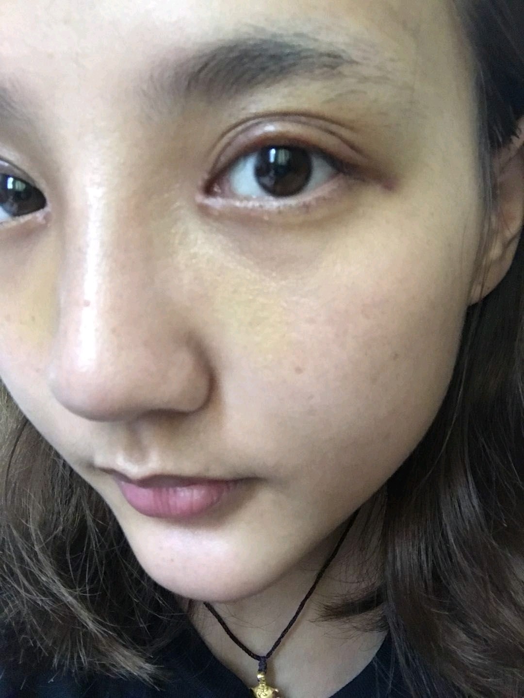 双眼皮术后变成三眼皮0101,是手术失败了吗_圈子-新氧美容整形