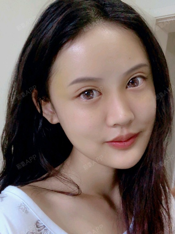 自体脂肪面部填充