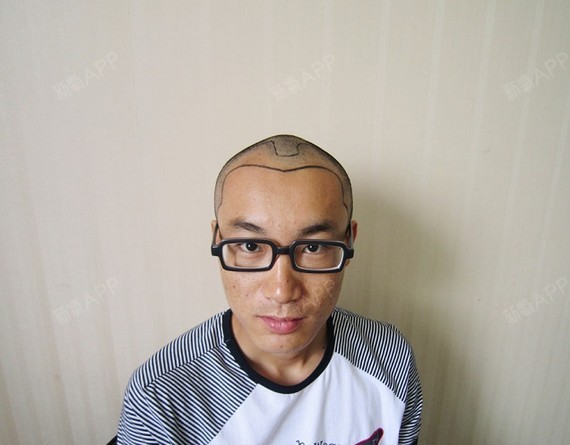 黑松沙士种植发际线第0天美丽日记-新氧美容整